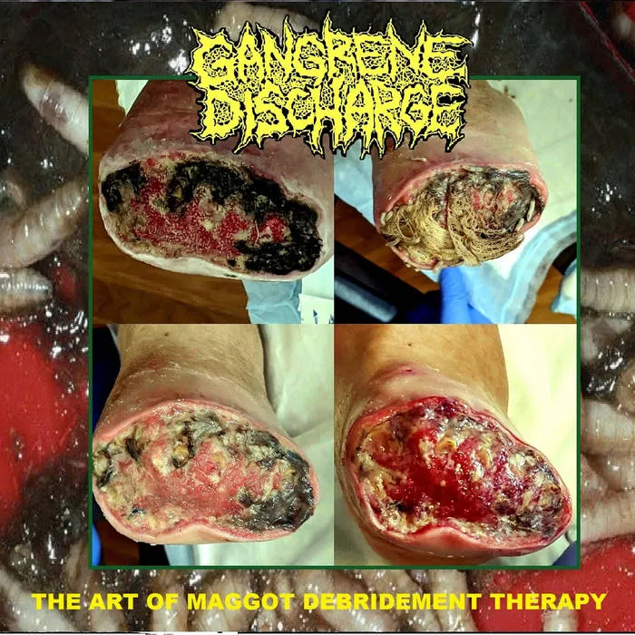 The Art of Maggot Debridement Therapy